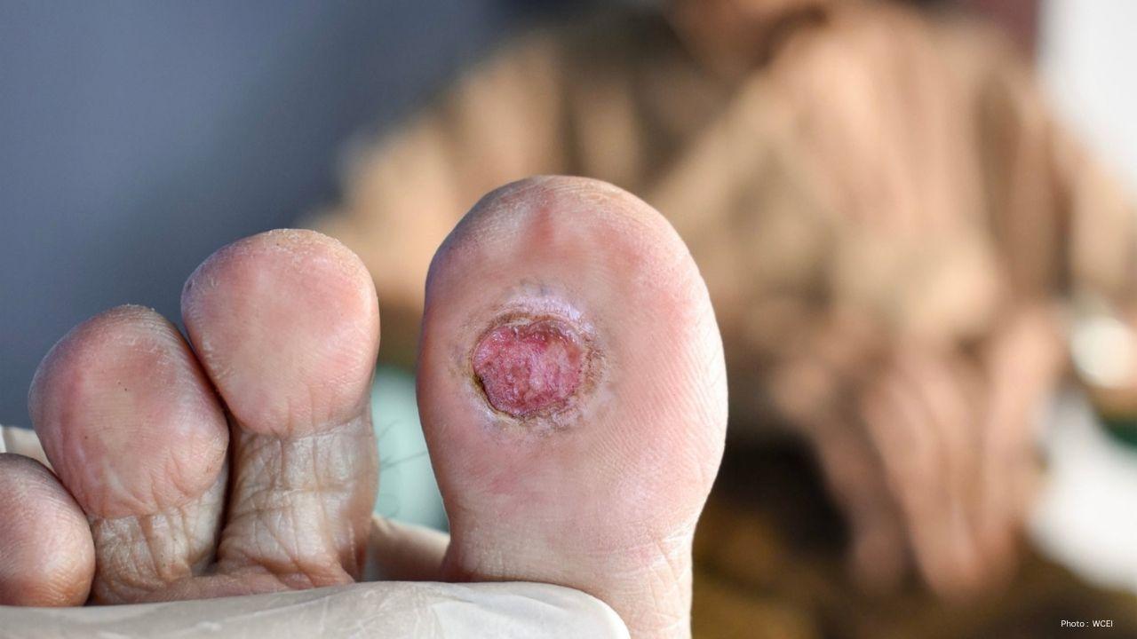 High Blood Sugar Slowly Damages Feet, Doctors Warn About Diabetic Foot Ulcers