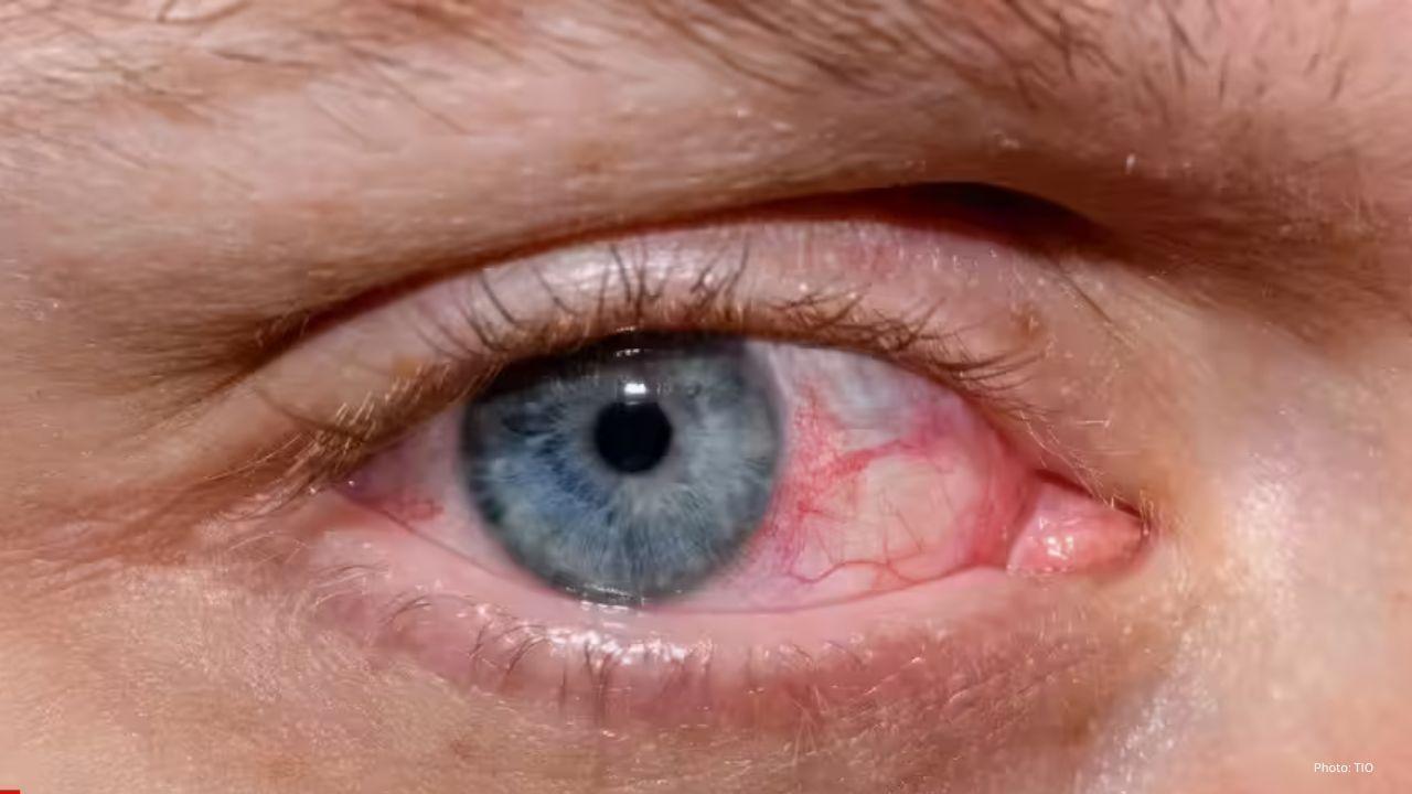 Why Delhi’s Air and Your Phone Are Secretly Ruining Your Eyes