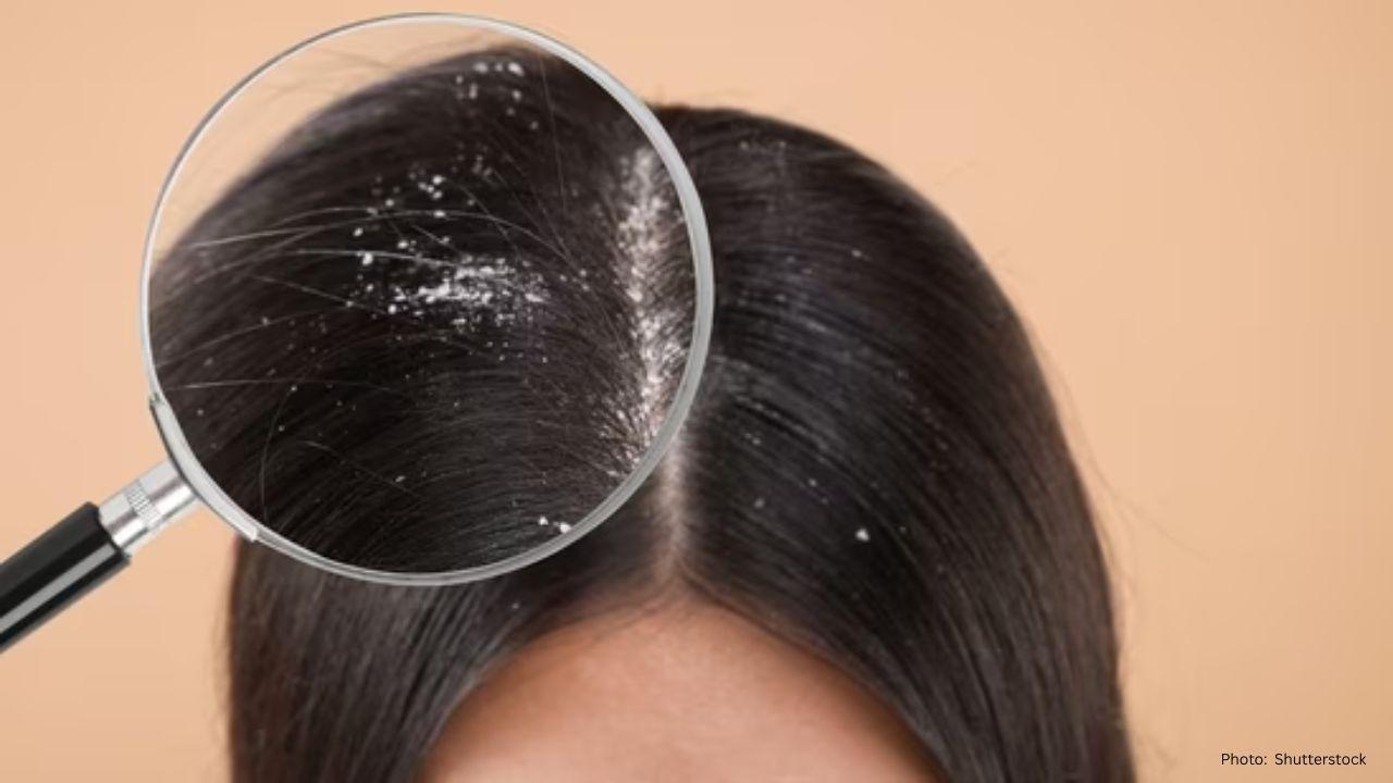 8 Effective Home Remedies for Dandruff Suggested by a Dermatologist