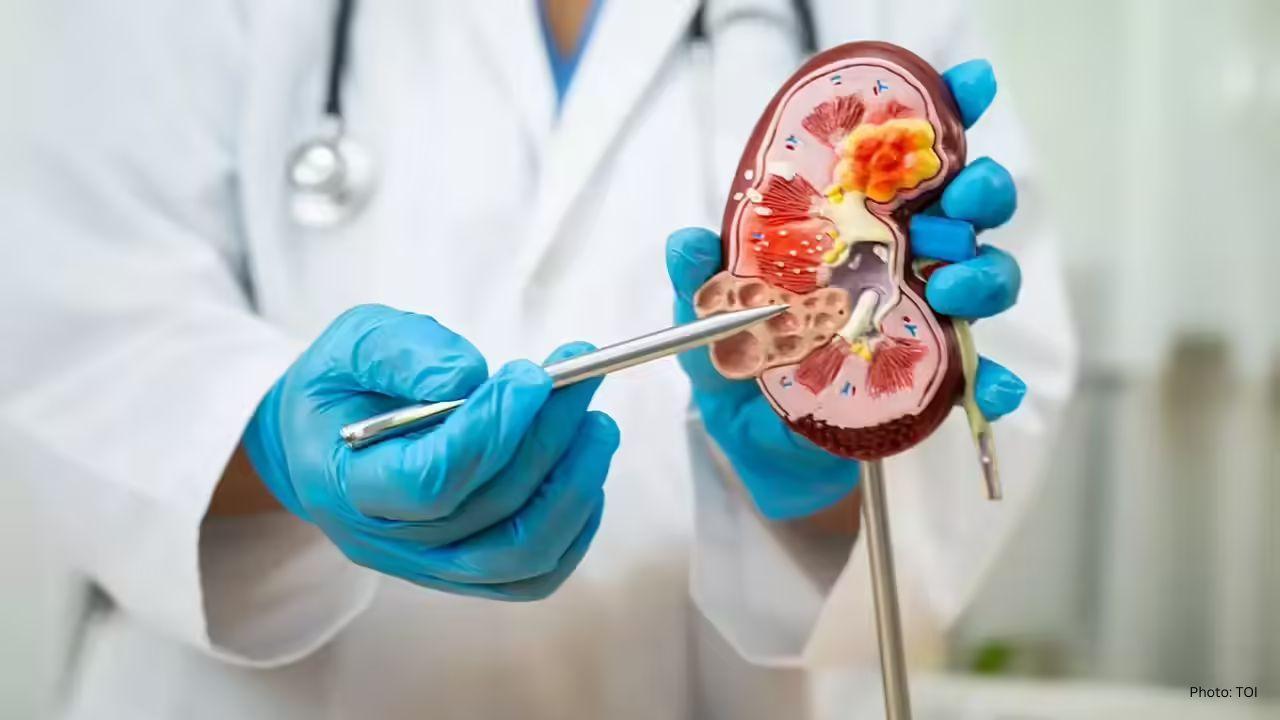 Expert Tips: 6 Simple Ways to Avoid Kidney Stones This Winter