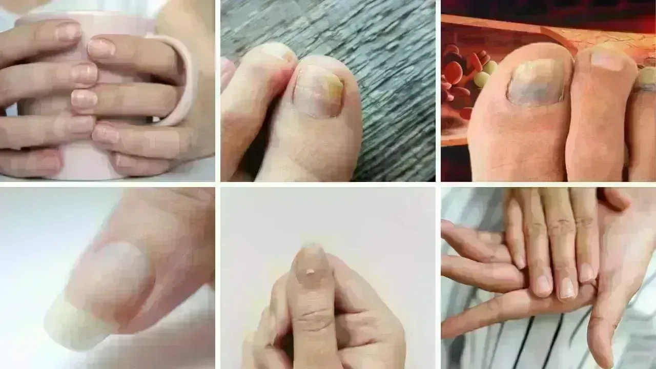 Seven Notable Nail Changes Indicating High Cholesterol Levels