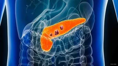 Revolutionary Daily Drug Offers New Hope in Pancreatic Cancer Treatment